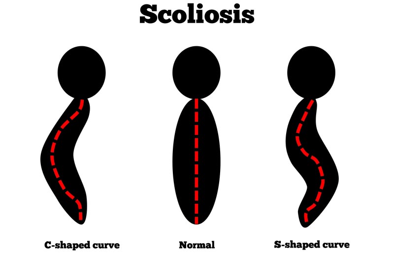 Yakima, WA scoliosis treatment